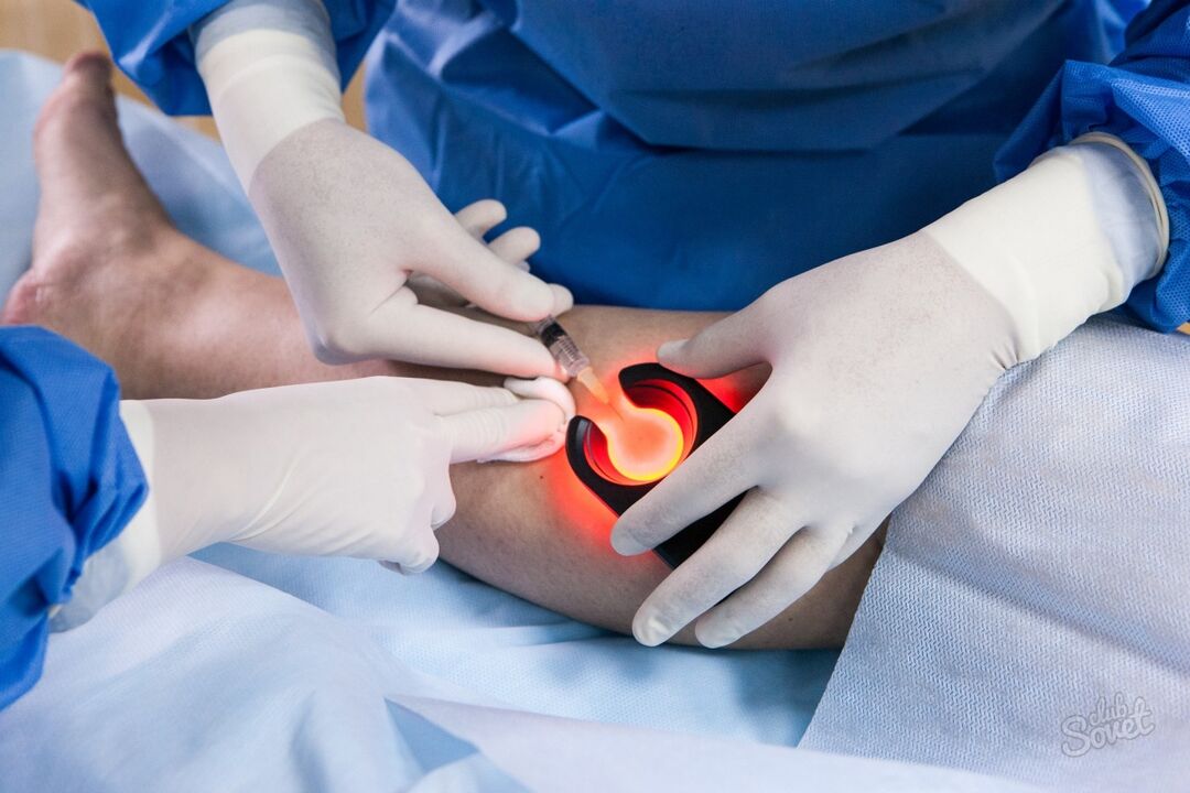 Varices on the diagnostic legs
