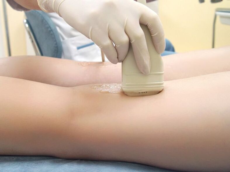 Varice treatment