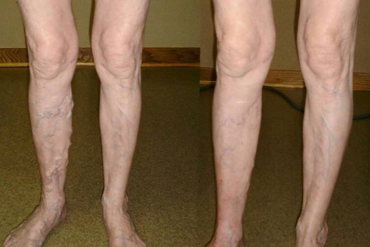 Varices in men