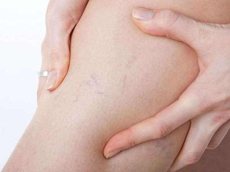 Varices on the legs
