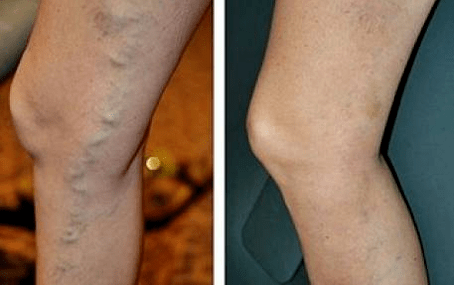 Varices veins before and after