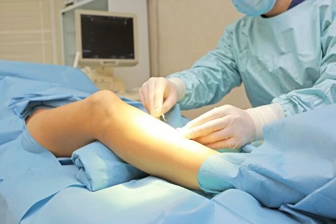 Operation for removing the veins on the legs