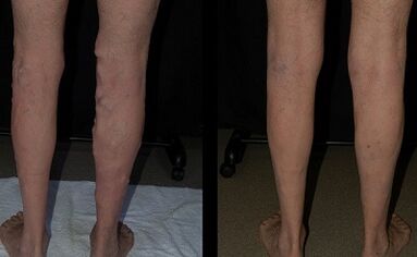 Various treatment with a laser photo before and after