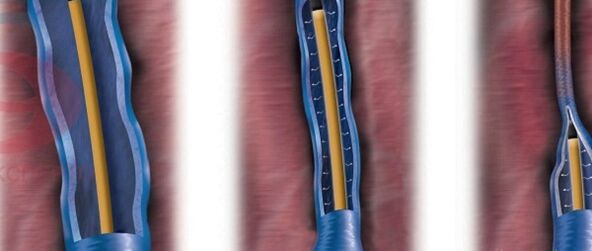 the essence of radiofrequency obliteration in the treatment of varicose veins