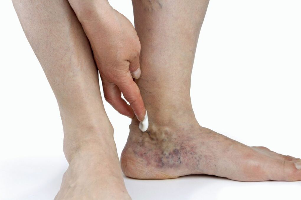 Lower limb varicose veins