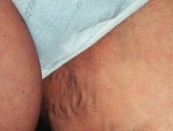 Pelvic varicose veins